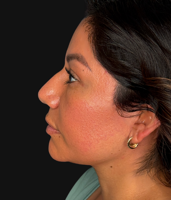 Left Profile After.png
