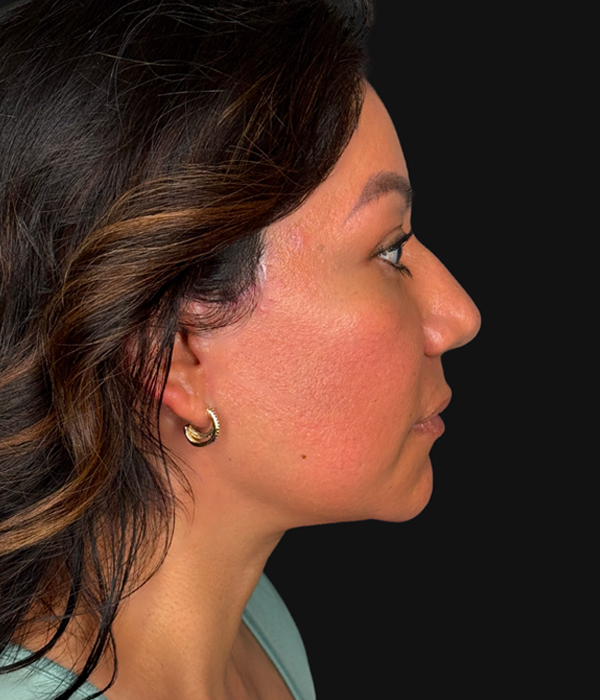 Right Profile After.png