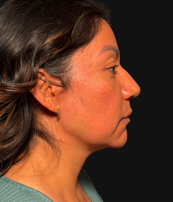 Right Profile Before.png