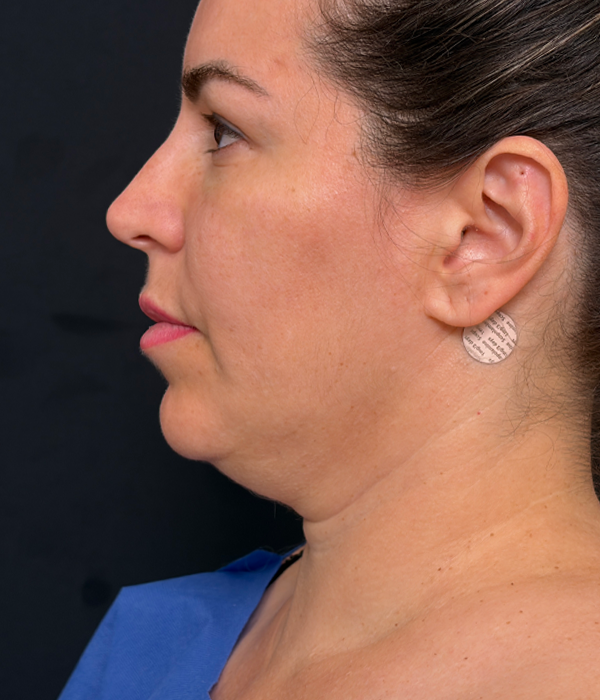 neckpreop