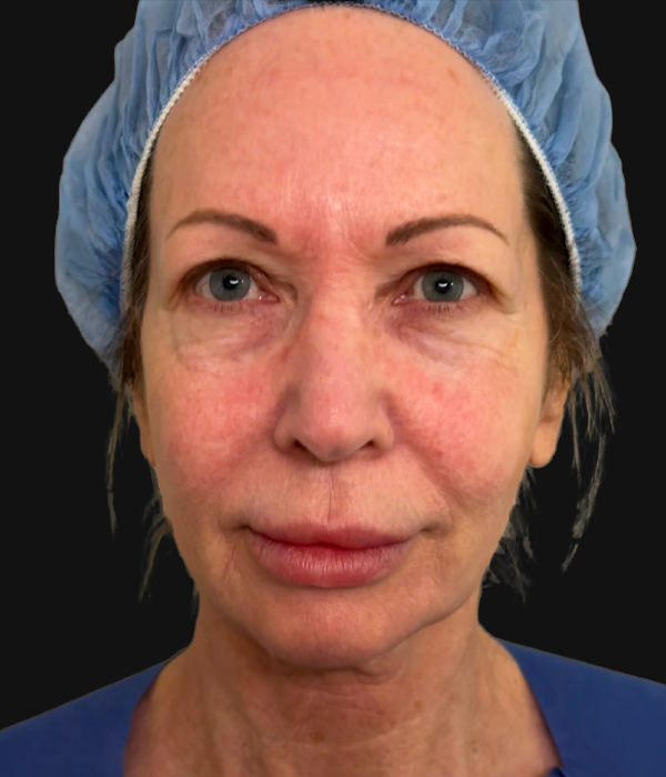 facelift (1).jpeg