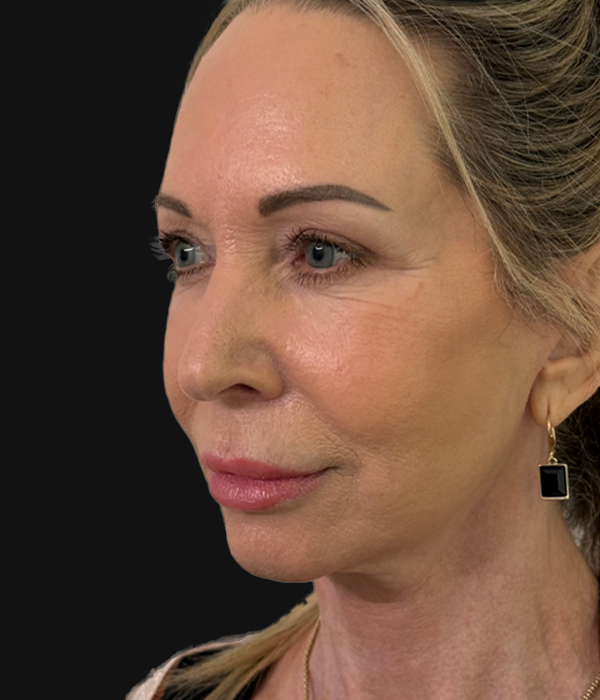 facelift (2).JPG