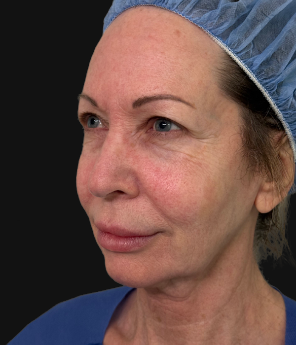 facelift (2).jpeg