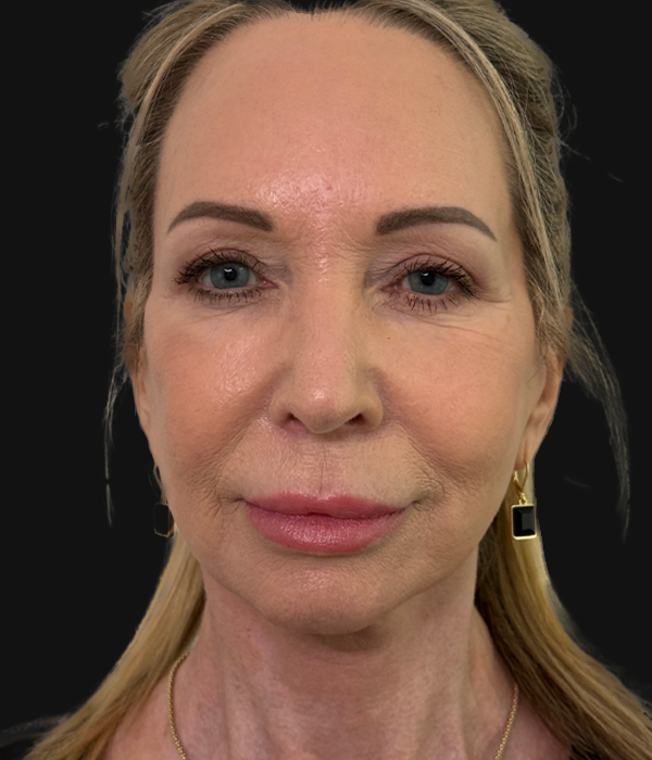 facelift (3).JPG