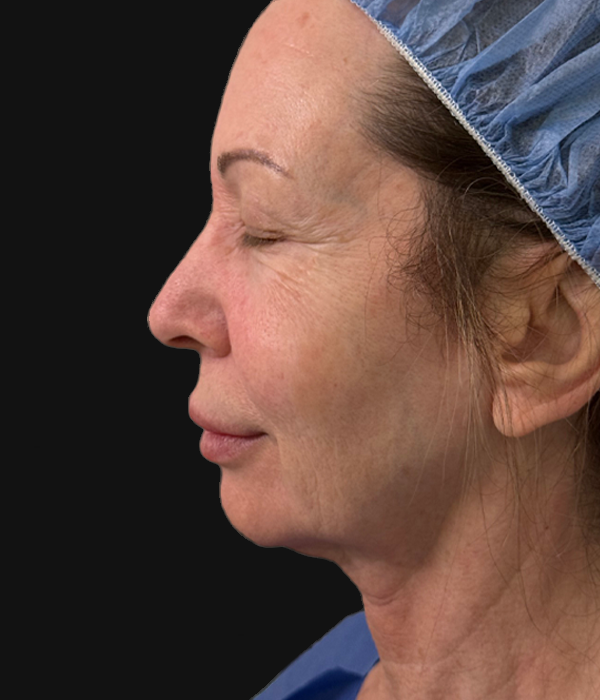 facelift (3).jpeg