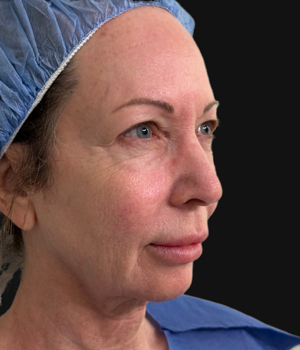 facelift (4).jpeg