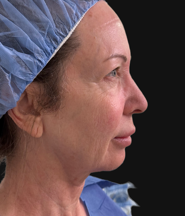 facelift (5).jpeg